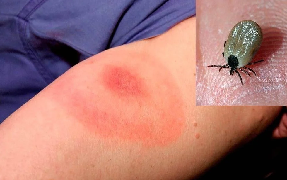 Van 10 muertes en juárez por rickettsiosis durante 2026; piden extremar precauciones